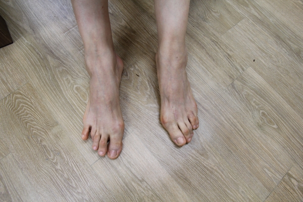 A씨는 류마티스관절염으로 발가락이 변형돼 휘어있다.